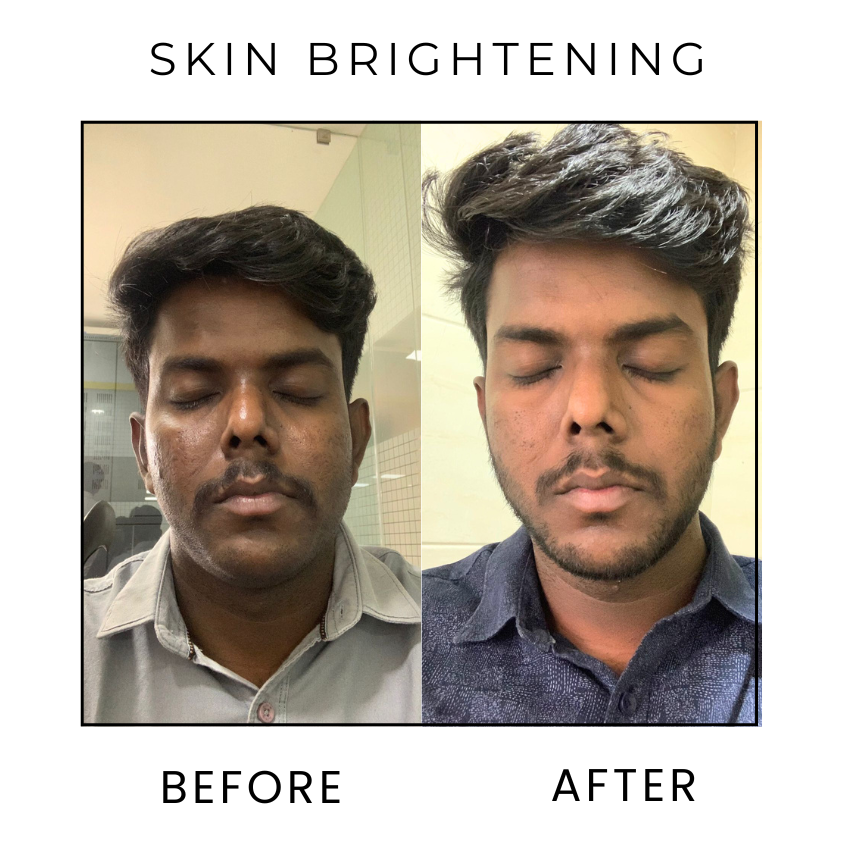 Skin-Brightening