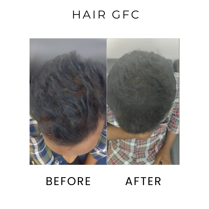 Hair GFC