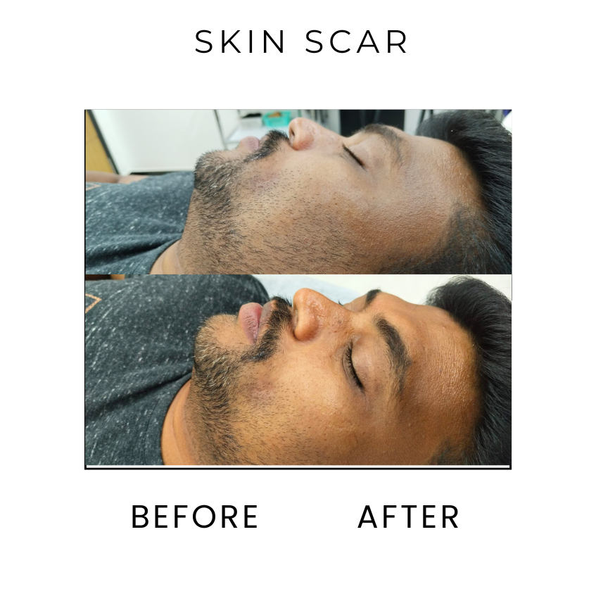 Skin scar